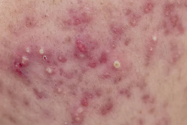 Acne på huden i ansiktet, dermatologiska sjukdomar akne Royaltyfria Stockfoton