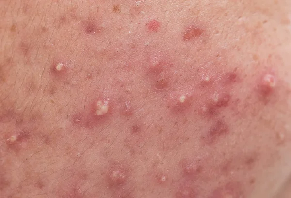 Hautprobleme in Nahaufnahme, knotige zystische Akne-Haut Stockbild
