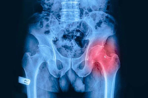 X-ray image of pelvis and hip from a human body part — Stock Photo, Image