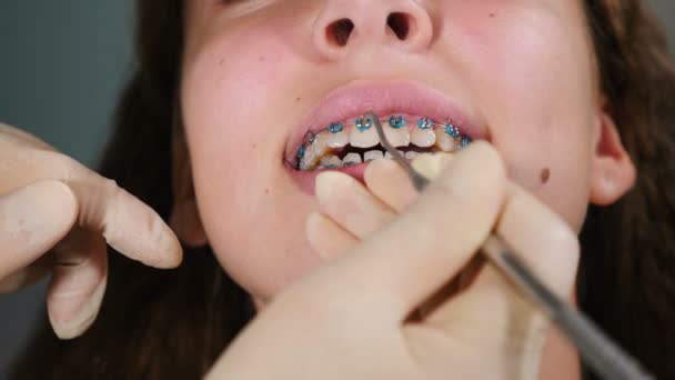 Dentista instalando aparelhos no paciente, close-up. Tratamento Ortodôntico. Dentes com aparelho dentário. Correcção de mordida. Ortodontista a trabalhar. Jovem atraente visitando ortodontista em odontologia moderna — Vídeo de Stock