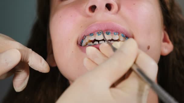 Dentista instalando aparatos ortopédicos en el paciente, de cerca. Tratamiento ortodóncico. Dientes con frenos dentales. Corrección de mordida. Ortodoncista trabajando. Atractiva joven mujer visitando ortodoncista en odontología moderna — Vídeos de Stock