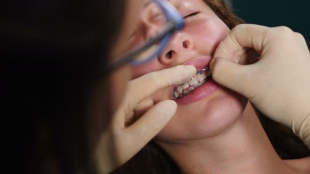 Processo de instalação de aparelho dentário no paciente, close-up. Tratamento Ortodôntico. Dentes com aparelho dentário. Correcção de mordida. Ortodontista a trabalhar. Jovem atraente visitando ortodontista na moderna — Vídeo de Stock