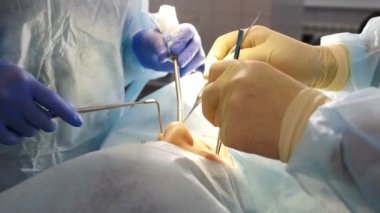 Dental health concept. Serious surgery in dental clinic. Surgeon implants dentures to patient. Close-up shot of oral dental surgery. Dentist and assistant during teamwork. 4 k video