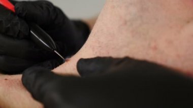 Papilloma elektropıhtılaşması. Siyah eldivenli kozmetik uzmanı güzellik kliniğinde erkek boynundaki papillomları alıyor. Dermatolojik tedavi. Doktor bir gün cildindeki kozmetik maddelerin lazerle alındığını söyledi.