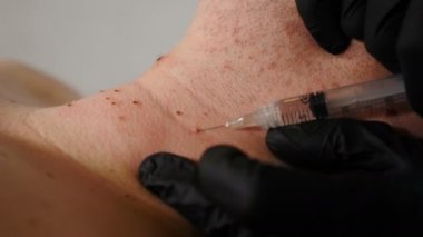Güzellik kliniğindeki erkek müşteri. Siyah eldivenli cerrah tıbbi işlemden önce ağrı kesici enjeksiyon yapıyor. Mol ve Papillomas tıbbi merkezden alınıyor. Doktor erkek derisindeki papillomu alıyor.