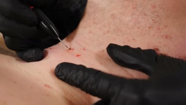 Male client in beauty clinic. surgeon in black gloves making medical procedure. mole and Papillomas removing in medical centre.Doctor removes papilloma off male skin. 4k — 图库视频影像