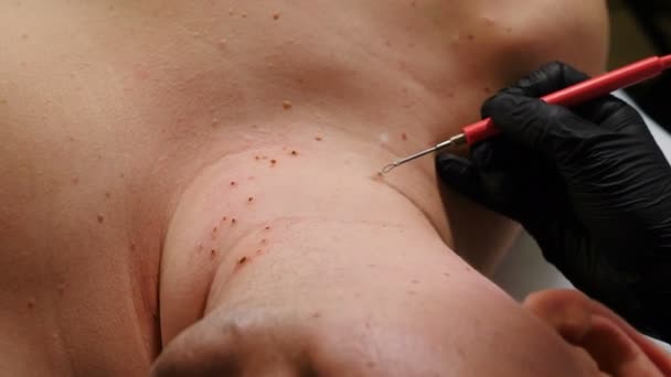 Электрокоагуляция папилломы. Хирург удаляет папилломы на мужской шее с помощью лазера в клинике красоты, дерматологическое лечение. Врач делает лазерное удаление опухолей на коже, косметическая однодневная операция. 4 месяца — стоковое видео