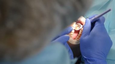 Dental industry concept. Close-up shot on female dentist working in clinic. Back view. Cosmetic dentistry veneers. Modern dental equipment and installation procedure of veneers. 4 k footage