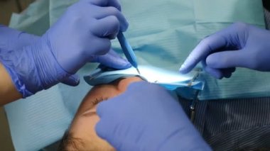 Dental clinic concept, Setting of veneers in modern dentistry. Close-up shot of female patient in chair having porcelain veneers installation procedure, Dental and teethcare care concept. 4 k video