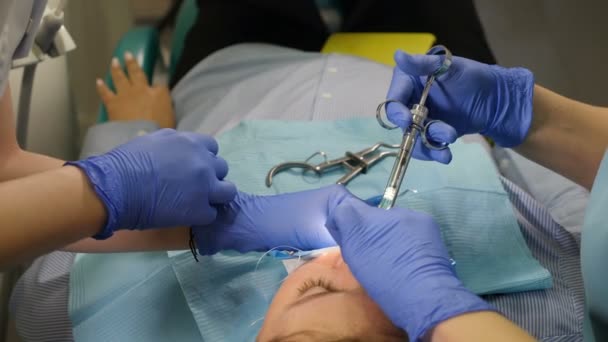 Dental clinic concept, Setting of veneers in modern dentistry (em inglês). Imagem de close-up de paciente do sexo feminino em cadeira com procedimento de instalação de folheados de porcelana, conceito de cuidados dentários e dentários. 4 k vídeo — Vídeo de Stock