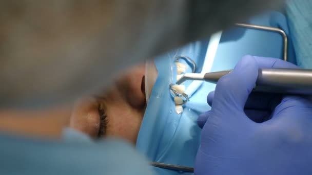 Concepto de clínica dental, Entorno de carillas en odontología moderna. Primer plano de la mujer paciente en silla que tiene chapas de porcelana procedimiento de instalación, Dental y el concepto de cuidado de los dientes. 4 k vídeo — Vídeos de Stock