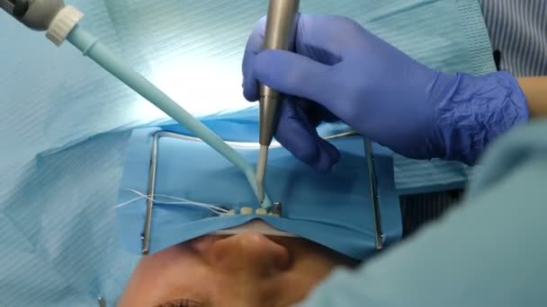 Concepto de clínica dental, Entorno de carillas en odontología moderna. Primer plano de la mujer paciente en silla que tiene chapas de porcelana procedimiento de instalación, Dental y el concepto de cuidado de los dientes. 4 k vídeo — Vídeos de Stock