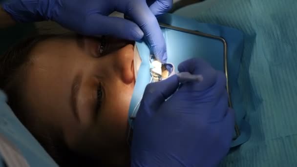 Specjalista od stomatologii przygotowuje zęby pacjenta do oklein ceramicznych za pomocą specjalnych narzędzi. Ciemny obraz. Stomatologia kosmetyczna, medycyna, stomatologia. Nowoczesna technika medyczna okleina dentystyczna. 4 k — Wideo stockowe