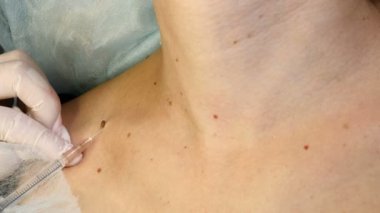 Kadın doktor, siğil çıkarmadan önce anestezi, ağrı kesici enjeksiyon yapıyor. Genç kadın vücudunda papilloma, yakın çekim. Nevus 'u ya da doğum lekesini çıkarıyorum. Kozmetik tedavi konsepti. 4 bin.