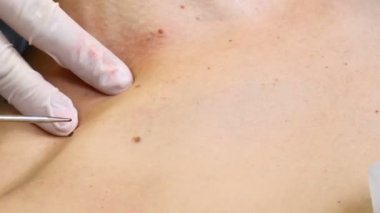 Ameliyat konsepti. Papilloma elektropıhtılaşması. Doktorun yakın çekimi, kadın vücudunda tıbbi aletler ve ekipmanlarla papillomavirüs yakıyor. Papillomas ameliyatı. 4k görüntü