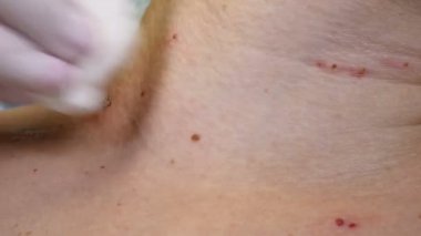 Güzellik kliniğinde. Güzellik uzmanı, cerrahi prosedürde beni tıbbi aletler ve ekipmanlarla kesip alıyor. Kadında tıbbi bir leke ve tıbbî merkezde alınan papillomlar var. 4k