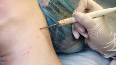 Güzellik kliniğinde. Güzellik uzmanı, cerrahi prosedürde beni tıbbi aletler ve ekipmanlarla kesip alıyor. Kadında tıbbi bir leke ve tıbbî merkezde alınan papillomlar var. 4k