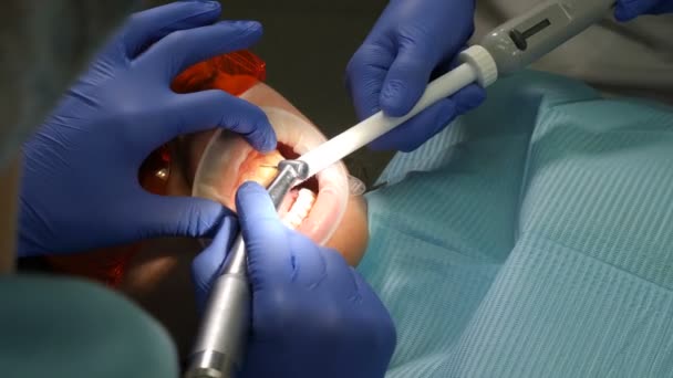 Zubař v práci, zblízka. Pacient podstupuje chirurgický zákrok a léčbu dutiny ústní v moderní stomatologii. Zuby se připravují na kosmetické dýhy. Postup instalace dýh. 4 k — Stock video