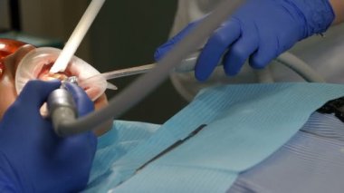 Dental clinic concept, Setting of veneers in modern dentistry. Close-up shot of female patient in chair having porcelain veneers installation procedure, Dental and teethcare care concept. 4 k video