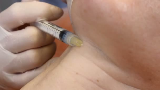 Procedura anti-invecchiamento della pelle: cosmetologo professionista effettua più iniezioni facciali lasciando tracce e papule. trattamento mesoterapia in corso. estetista tiene la siringa per iniezione. Primo piano. 4. — Video Stock