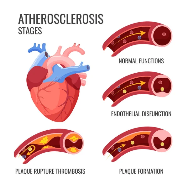 Estágios de aterosclerose. Funções normais, disfunção endotelial, formação de placas, trombose de ruptura —  Vetores de Stock