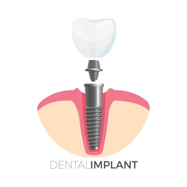 Dental implant diş ve vektör çizim vidalı