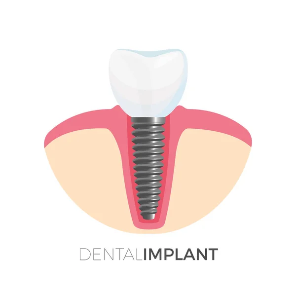 Cartel de implantes dentales con imagen en ilustración vectorial — Archivo Imágenes Vectoriales