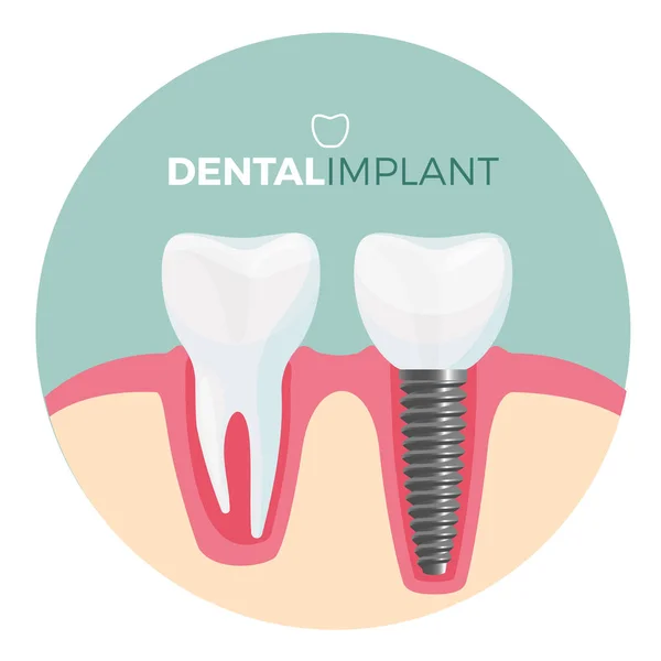 Placa de implante dental con título sobre ilustración vectorial — Archivo Imágenes Vectoriales