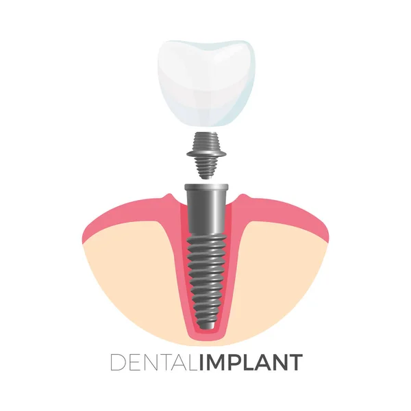 Diente de implante dental y tornillo en ilustración vectorial — Archivo Imágenes Vectoriales