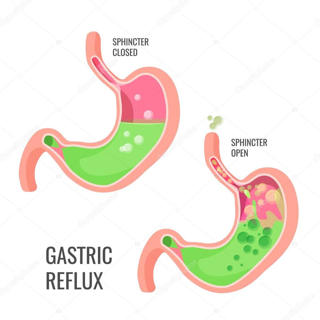 Gastric reflux medical promo poster with human organ