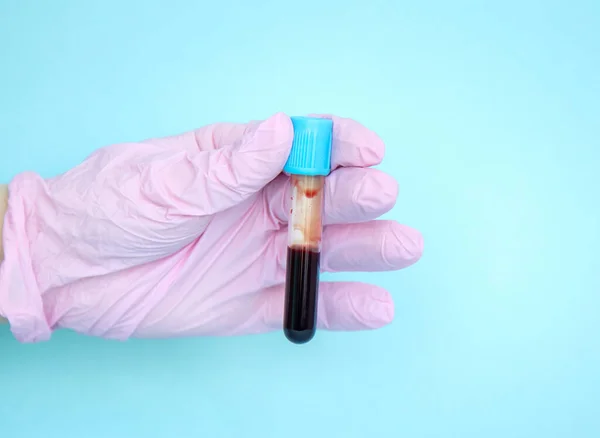 Medico Tiene Una Provetta Con Sangue Ricerca Analisi Laboratorio Sangue — Foto Stock