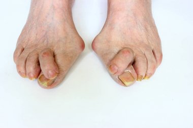 Medetcin, valgus bunyon, bacak deformitesi halluks valgus (bunyon) ile tedavi, metin için yer reddedilmesi sonucu