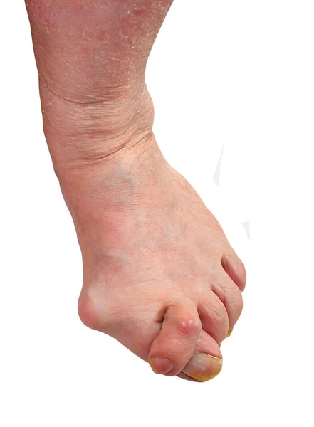 İlaç, tedavi, metin için yer reddedilmesi sonucu valgus bunyon, bacak deformitesi halluks valgus (bunyon) ile