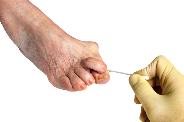 Medetcin, valgus bunyon, bacak deformitesi halluks valgus (bunyon) ile tedavi, metin için yer reddedilmesi sonucu