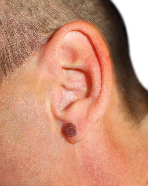 Man Large Mole His Ear Medicine Image Nevus Human Ear — Stock Photo, Image