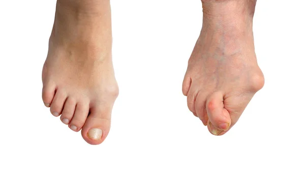 Medetcin Valgus Bunion Initial Stage Advanced Stage Disease Leg Deformity — Stock Photo, Image