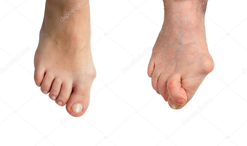 Medetcin, valgus bunion, Initial stage and advanced stage of the disease , leg with deformity valgus hallux (Bunion), the consequence of refusal of treatment, space for text