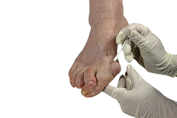 Medecin Juanete Valgo Pierna Con Deformación Valgus Hallux Juanete Consecuencia — Foto de Stock