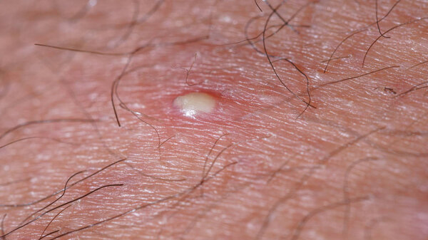 ingrown hair closeup