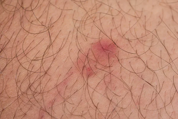 Closeup of redness over caucasian skin — Stock Photo, Image