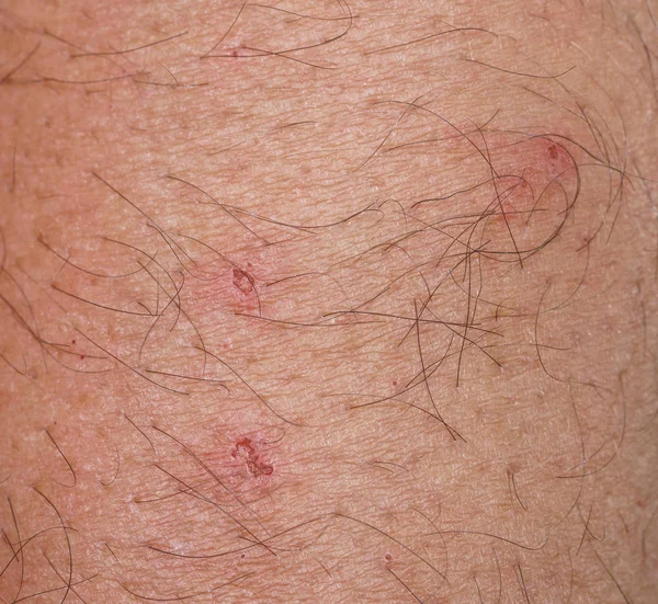 Closeup of spot with scab over caucasian skin — Stock Photo, Image