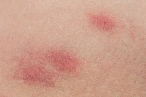 Close-up de picadas de pulgas — Fotografia de Stock