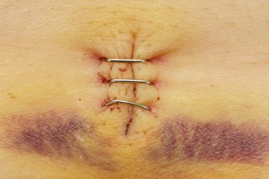 Bir yara yara ile metal zımba