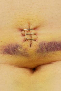 Bir yara yara ve göbek ile metal zımba