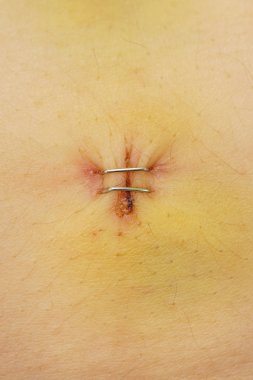 Beyaz Cilt üzerinde bir yara izi metal zımba