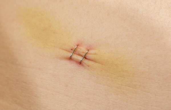 Metal staples in a scar over caucasian skin close-up