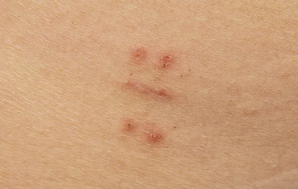 Scar with bruise closeup after hysterectomy — Stock Photo, Image