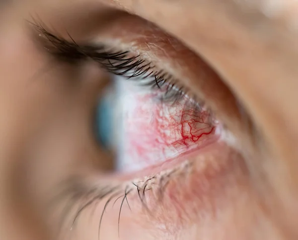 Eye profile view with mess of veins — Stock Photo, Image