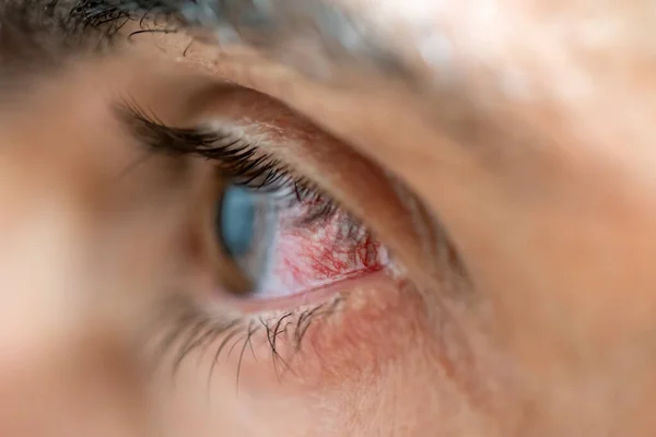 Vista del perfil del ojo caucásico con desorden de venas — Foto de Stock