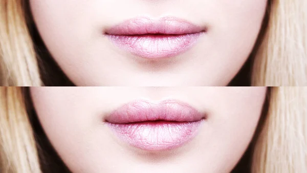 Part of face, young woman close up. Sexy plump lips after filler — Stock Photo, Image